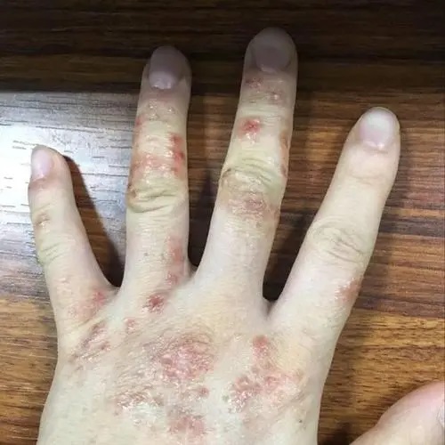 什么是湿疹,有湿疹一定要看